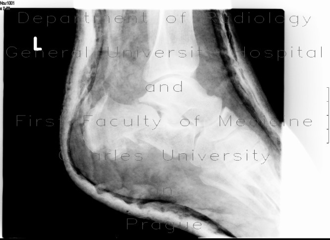 Fracture of calcaneus