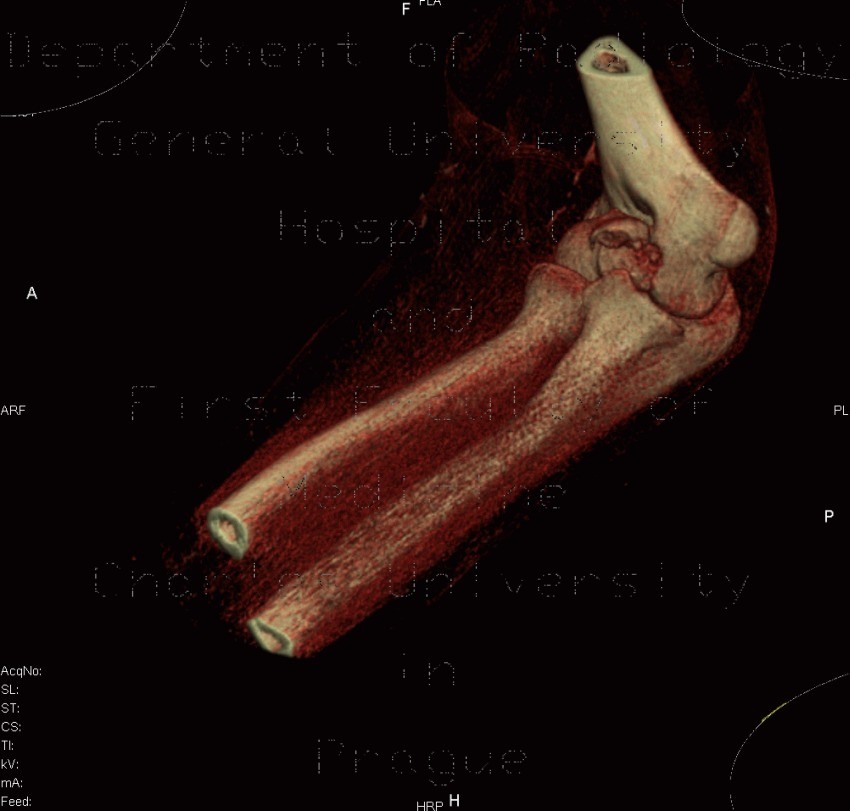 Fracture of capitulum humeri, VRT