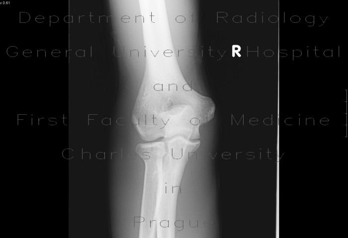 Fracture of capitulum radii