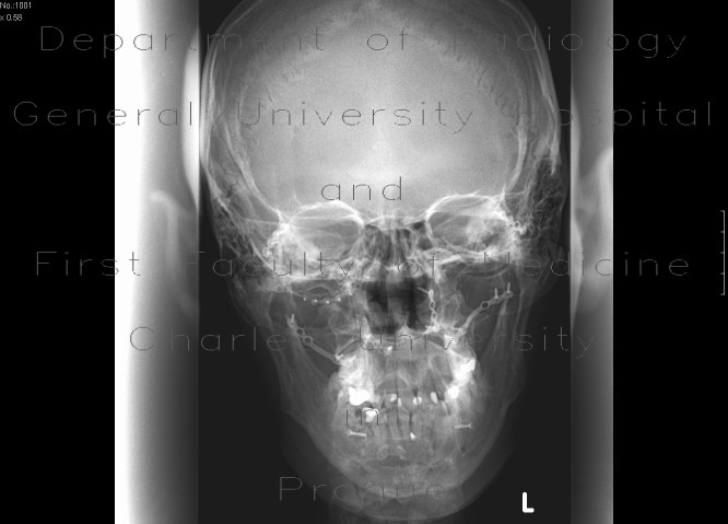 Fracture of facial skeleton, Le Fort III