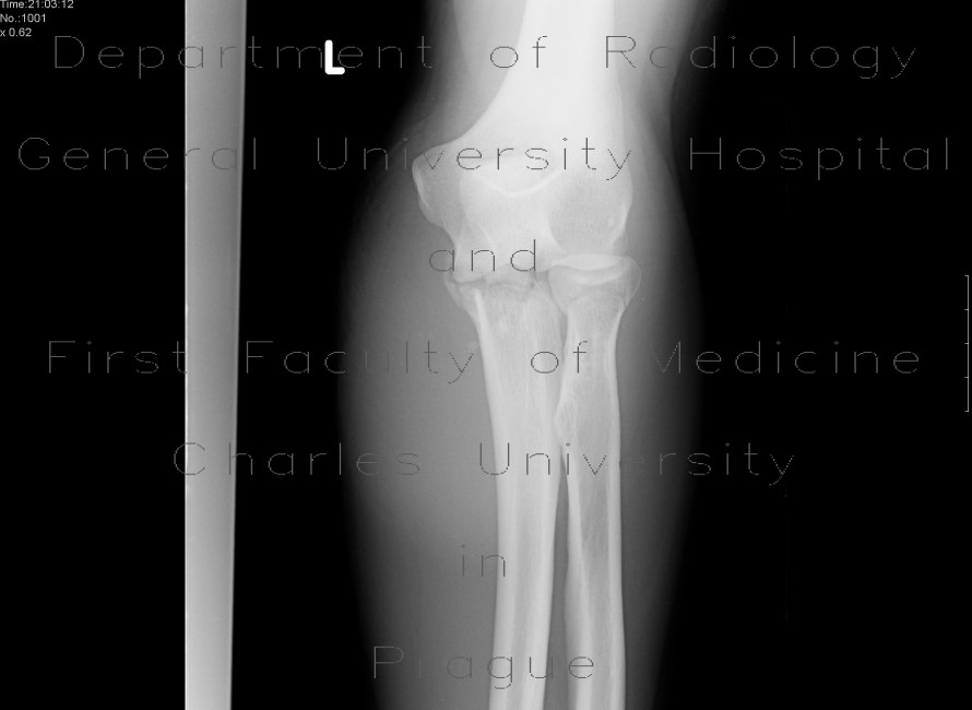 Fracture of foream bones