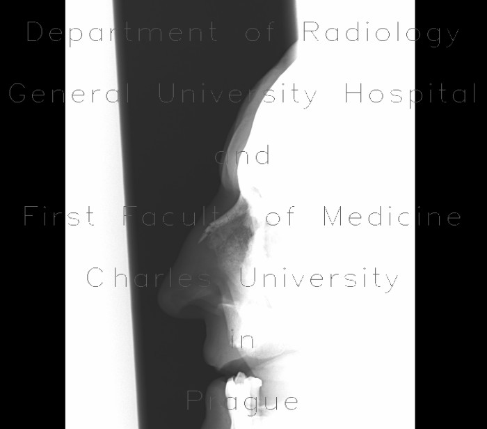 Fracture of nasal bones, comminuted