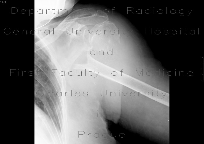 Fracture of neck of humerus