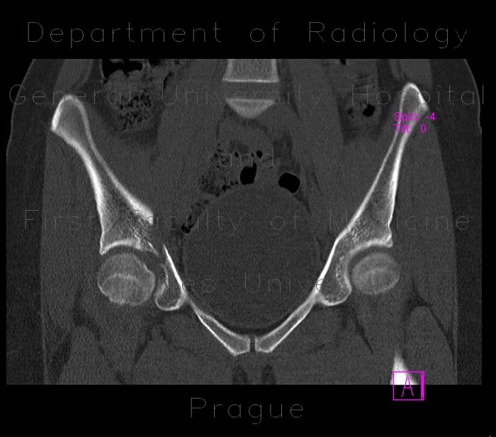 Fracture of pelvis - iliac bone and acetabulum