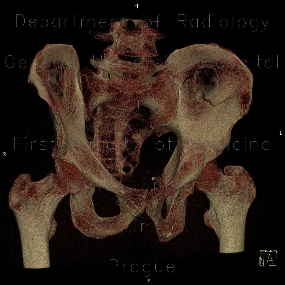 Fracture of pelvis, iliac wing, VRT