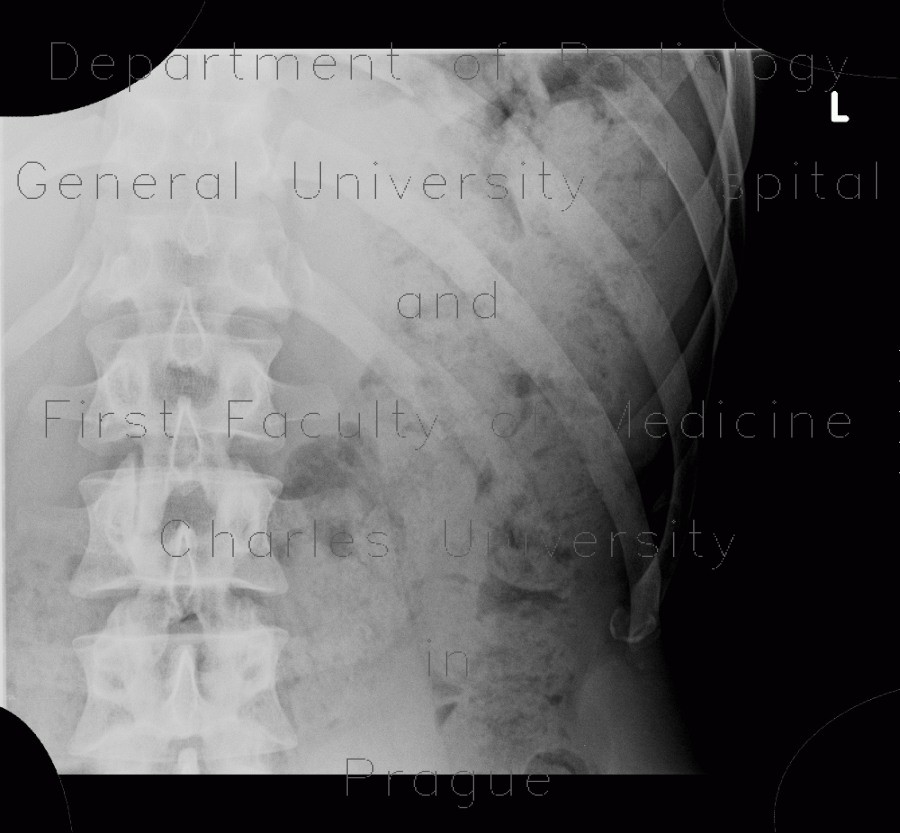 Fracture of rib, recognized on ultrasound