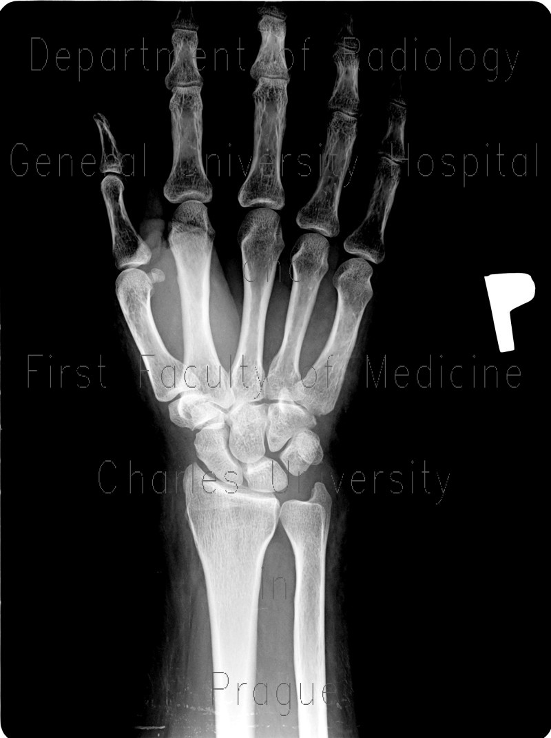 Fracture of scaphoid bone