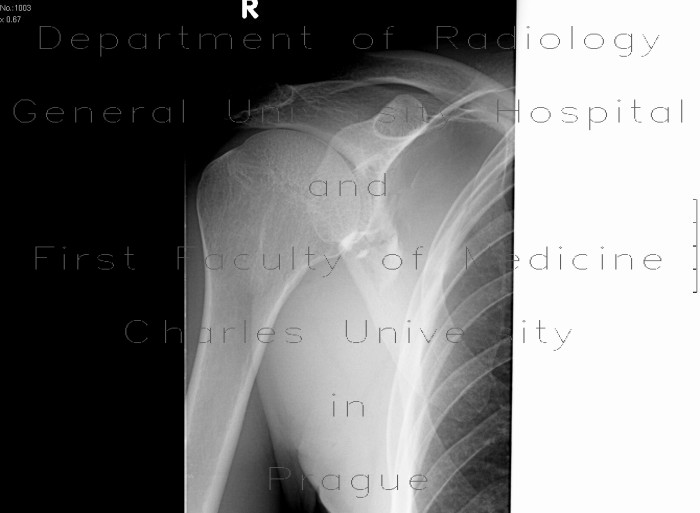 Fracture of scapula, shoulder blade