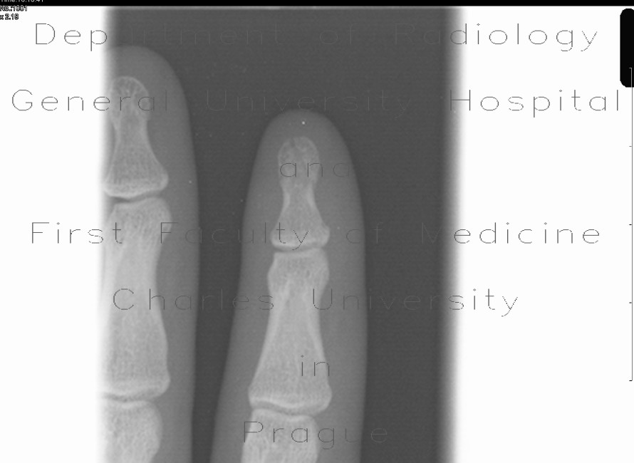 Fracture of the distal phalangeal tuberosity