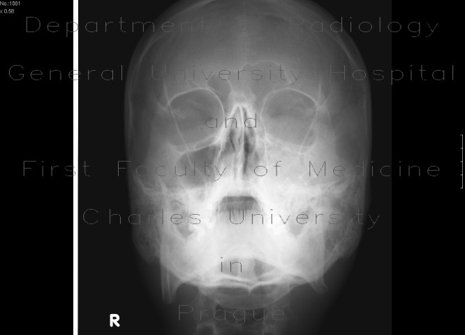Fracture of the left zygomatico-maxillary complex