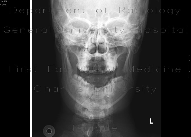 Fracture of the mandible