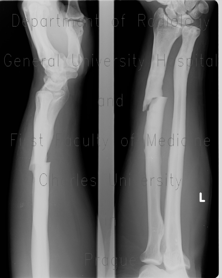 Fracture of the shaft of radius, secondary healing, malunion