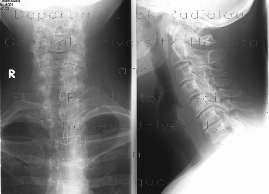 Fracture of the spinous process C6 - Clay shoveler's fracture
