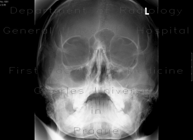 Fracture of the zygomatico-maxillary complex, left side, hemosinus