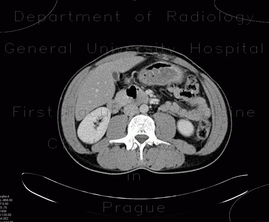 Fracture of thoracic vertebra, epidural hematoma of the spinal canal