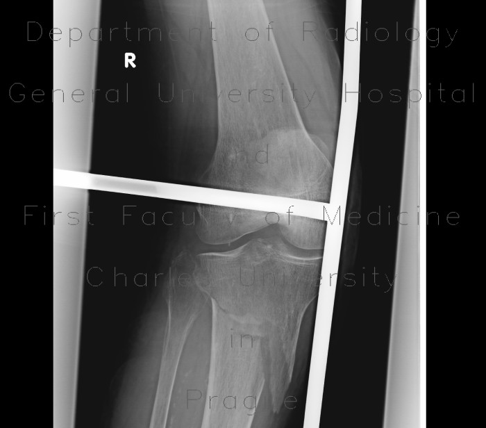 Fracture of tibia