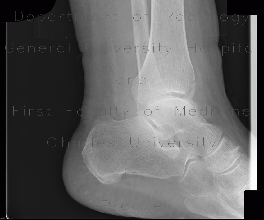 Fracture of tibial malleolus