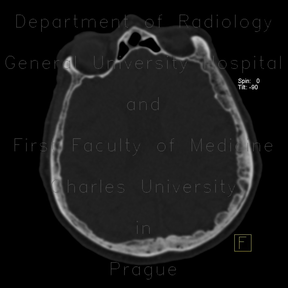 Frontal hyperostosis, endocraniosis