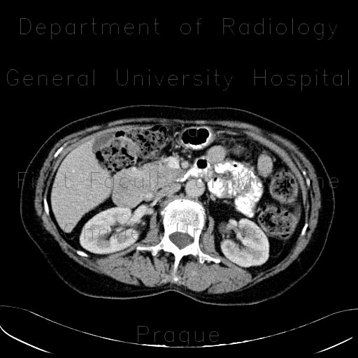 GIST of duodenum, gastrointestinal stromal tumour