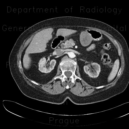 GIST of stomach, gastrointestinal stomal tumour