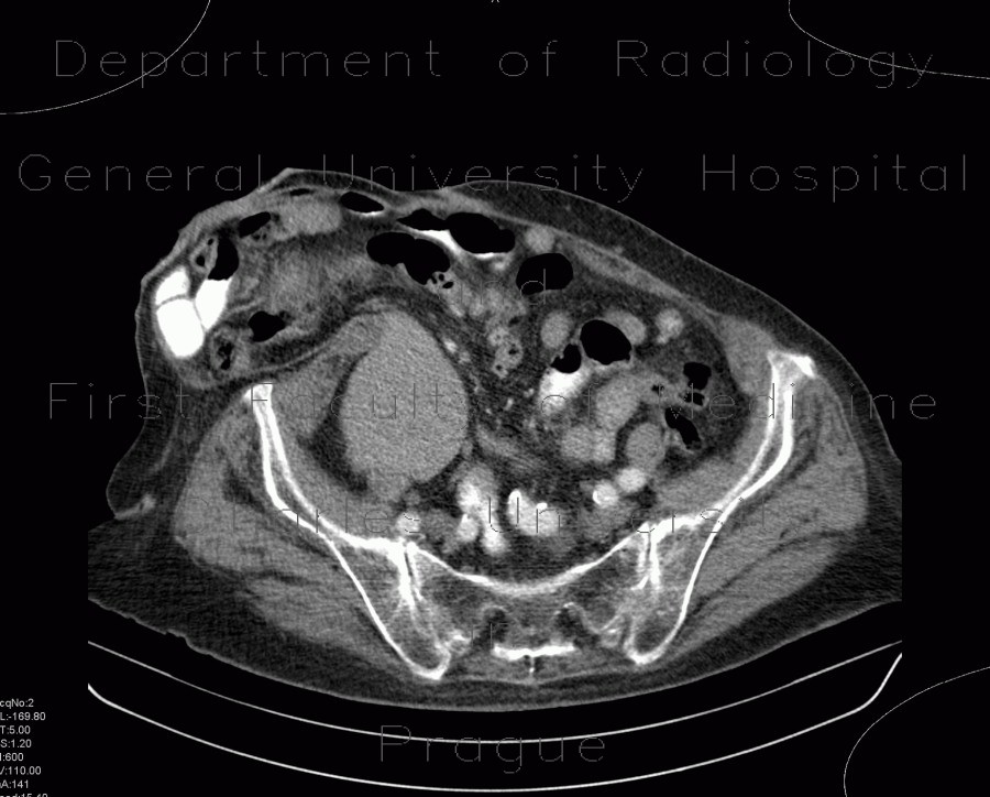 Gallstones, cholecystolithiasis, incisional hernia
