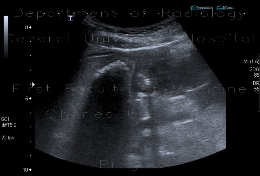 Gallstones, cholesterol, floating