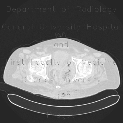 Gangrene of perineum and ischiorectal fossa, Fournier gangrene
