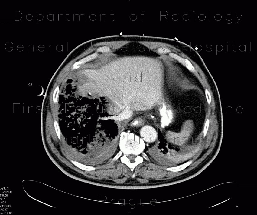 Gangrene of the liver