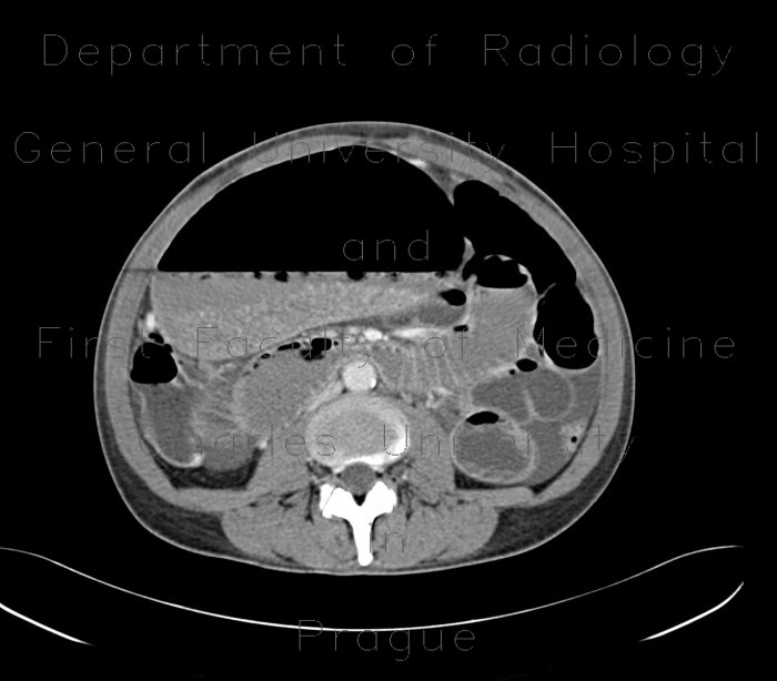 Gastrectasia, distension of stomach, ileus