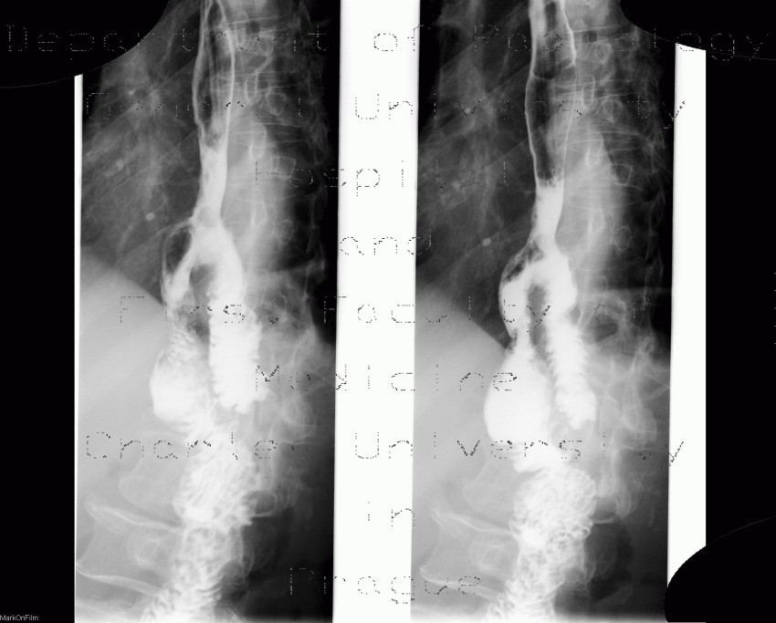 Gastrectomy, end-to-side anastomosis