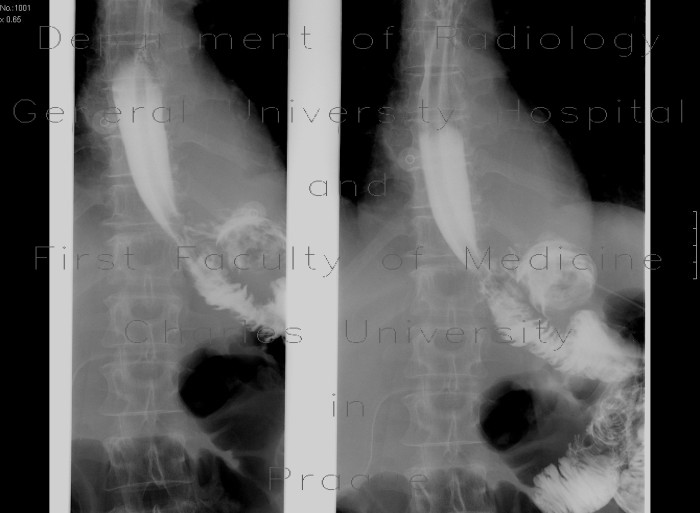 Gastrectomy, esophago-entero-anastomosis