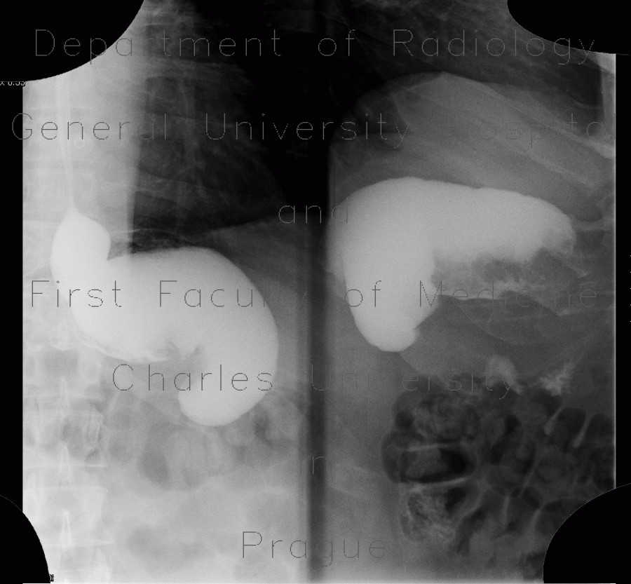 Gastroplication, bariatric surgery of stomach