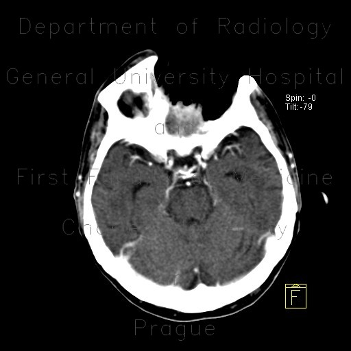 Gigantic defect in face after resection of carcinoma