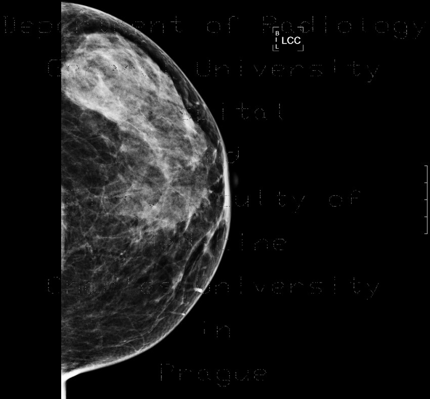 Glandular type, normal mammography, 