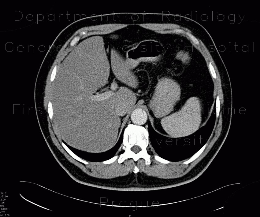 Hemangioma, CEUS