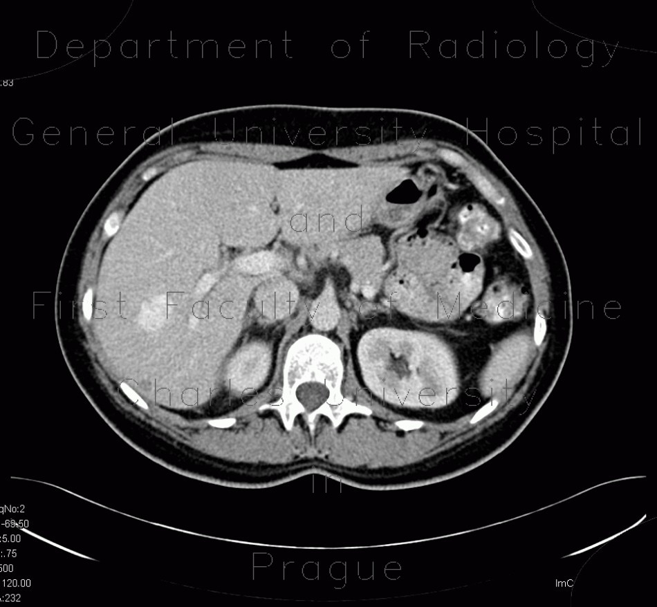 Hemangioma, cavernous hemangioma