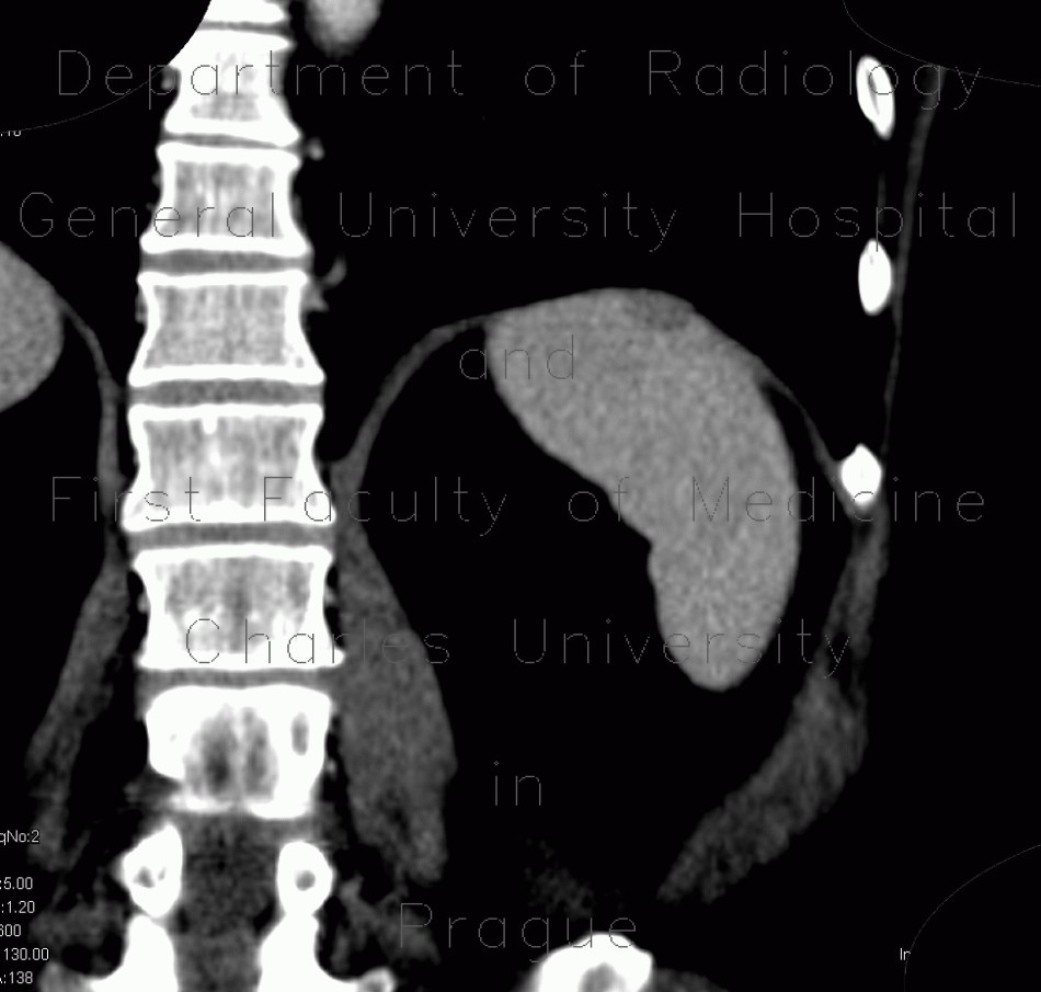 Hemangioma of spleen, splenic hemangioma