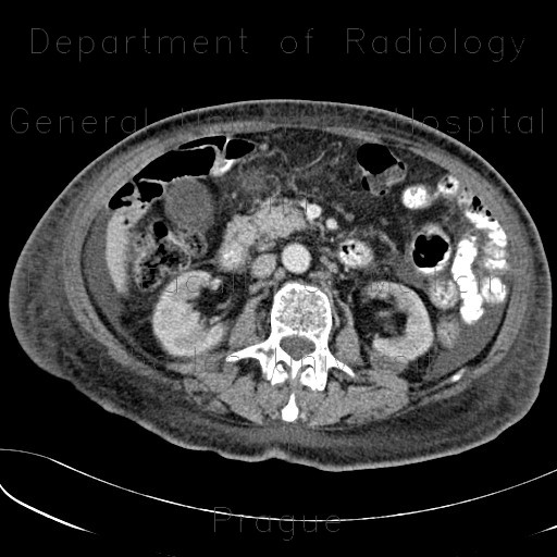 Hematoma after renal biopsy
