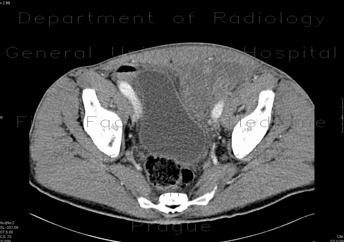 Hematoma after repair of inguinal hernia