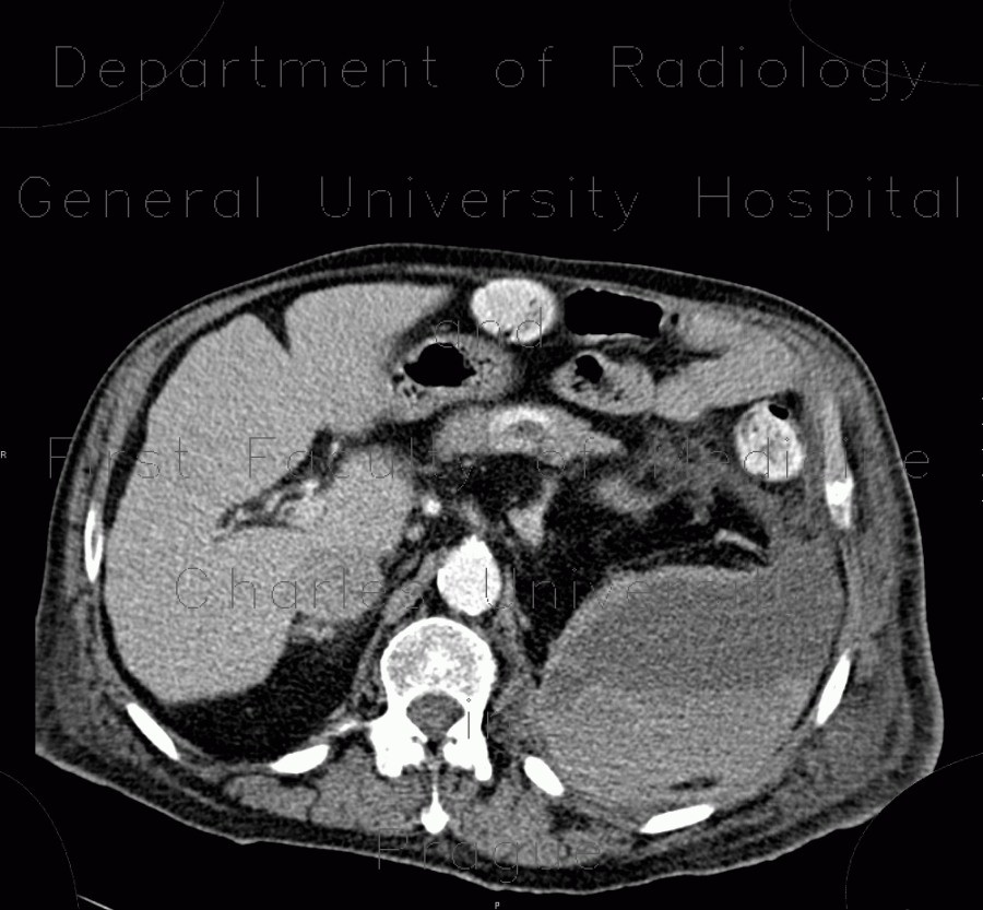 Hematoma in psoas muscle, large, anticoagulation therapy, anticoagulant