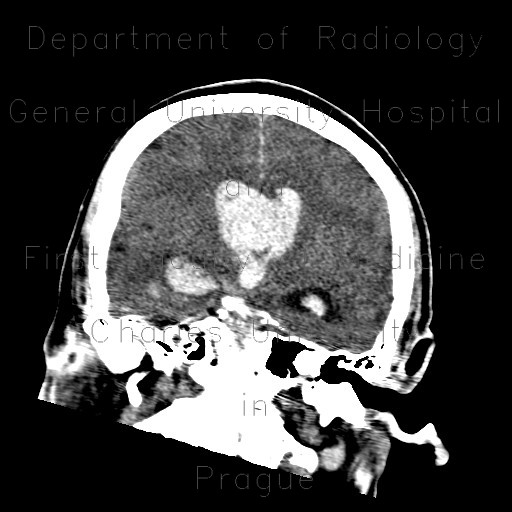 Hemocephalus, ventricular bleeding