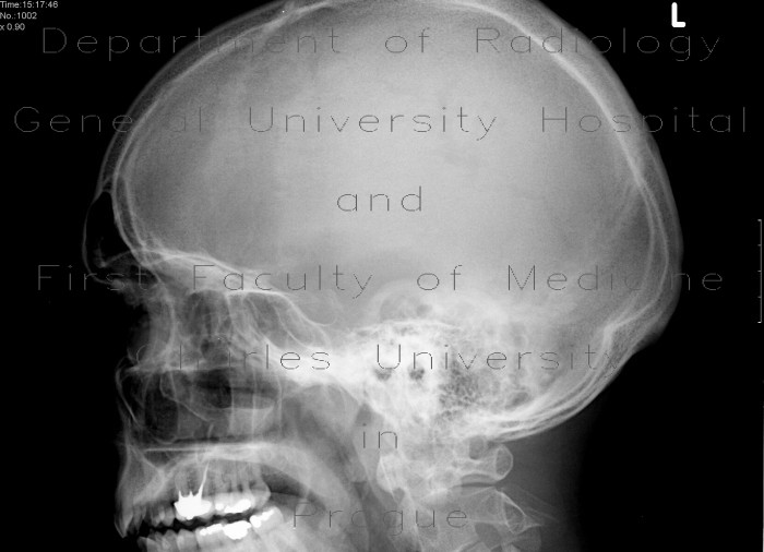 Hemosinus, fracture of maxillary sinus