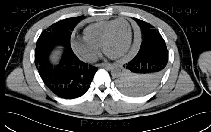 Hemothorax, hemopericardium