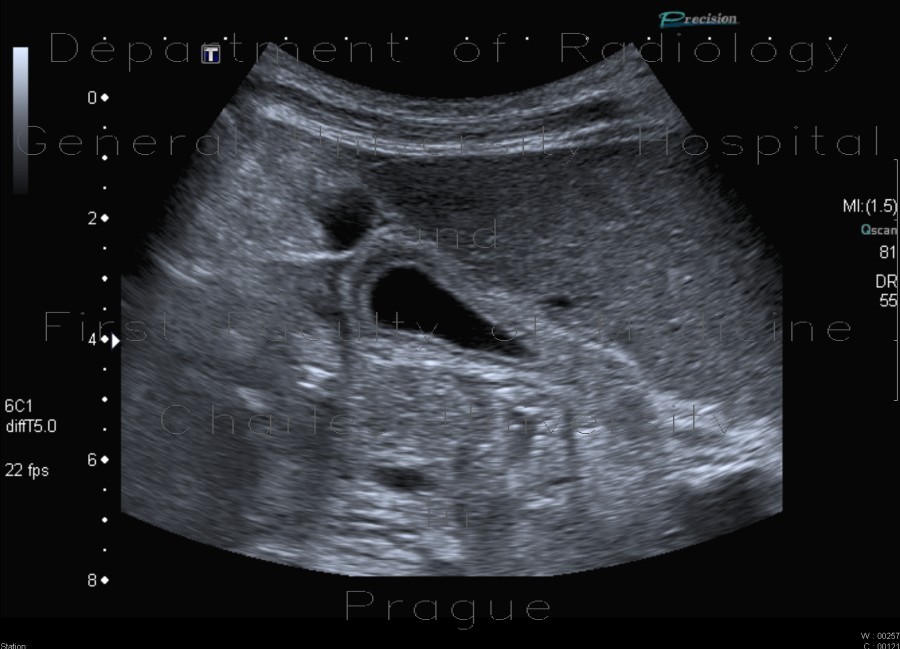 Hepatitis, lues