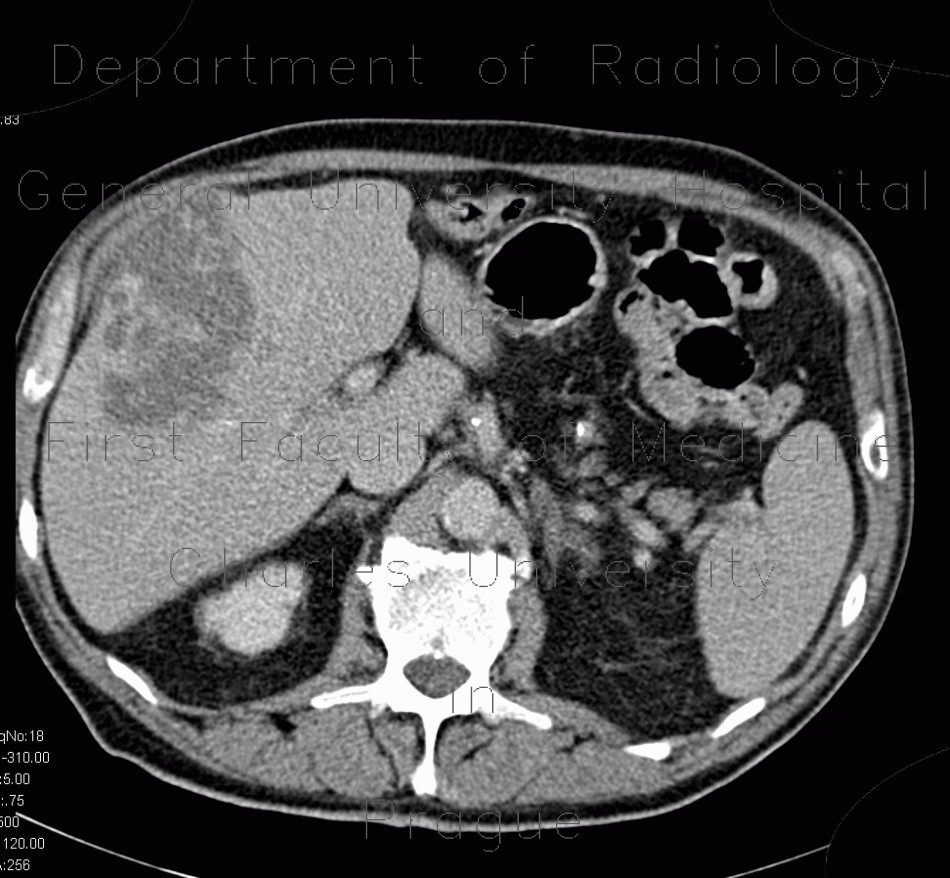 Hepatocellular carcinoma, subcapsular bleeding