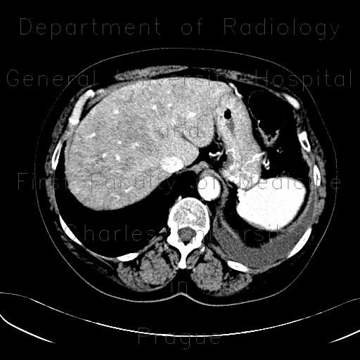 Hepatopathy after chemotherapy