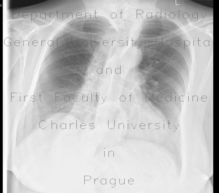 Hiatal hernia