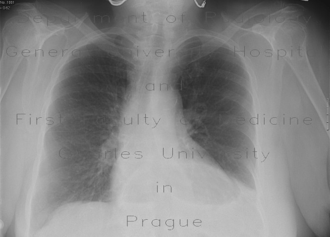 Hiatal hernia, chest radiograph