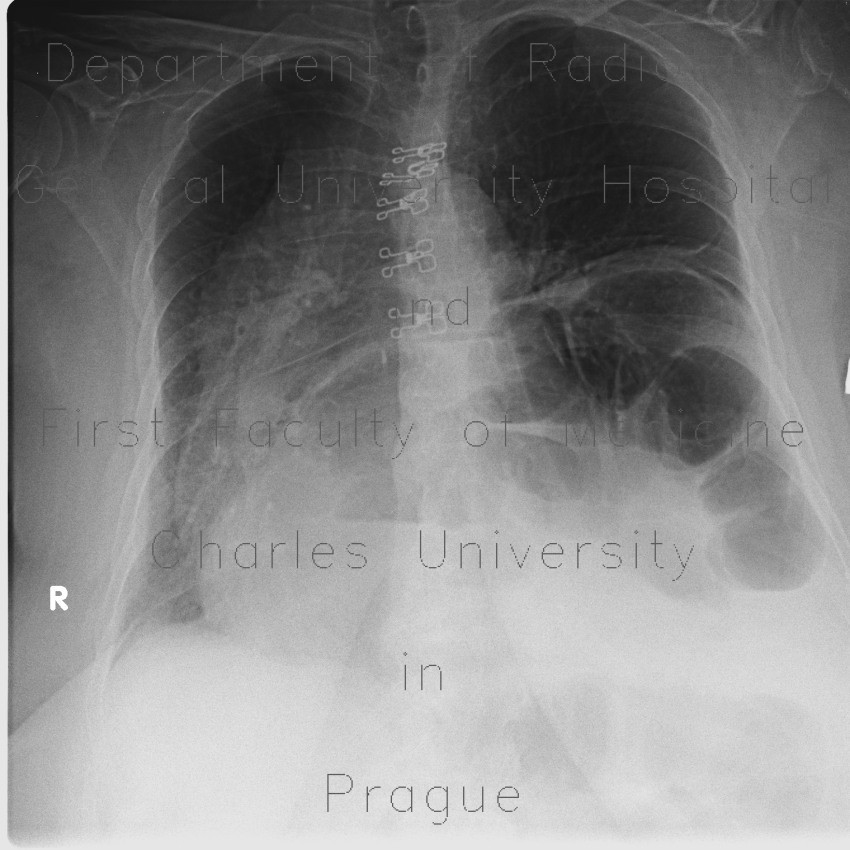 Hiatal hernia, upside-down stomach