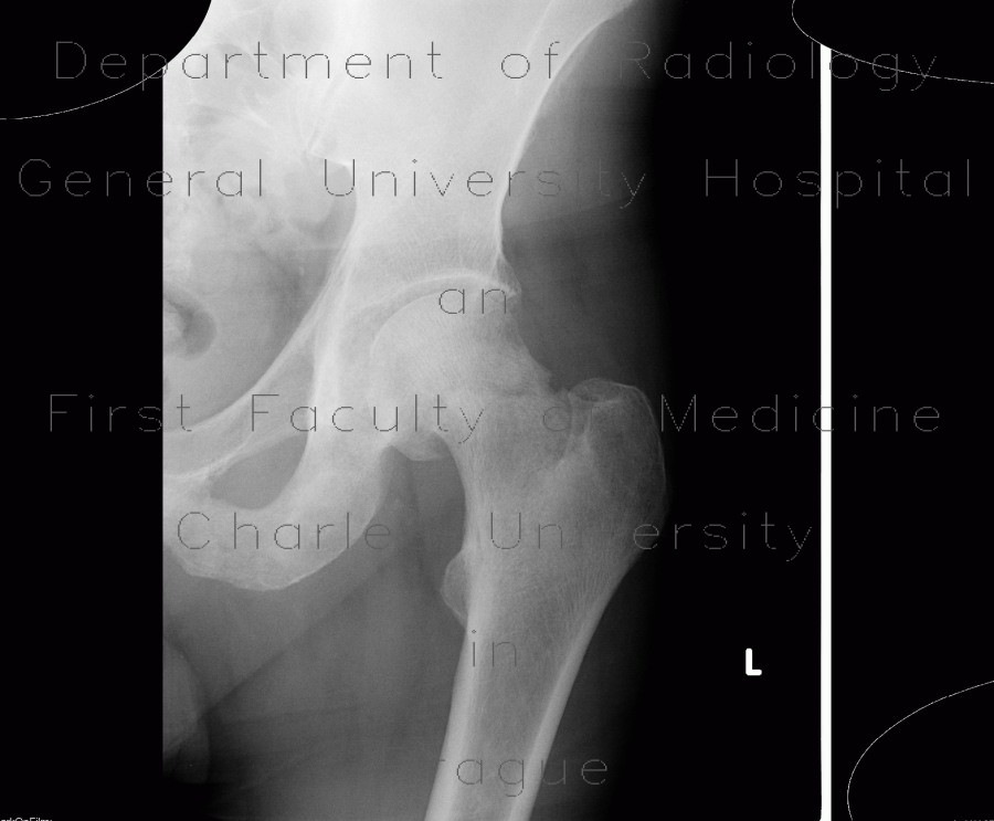 Hip fracture, femoral neck, subcapital fracture, Pauwels A